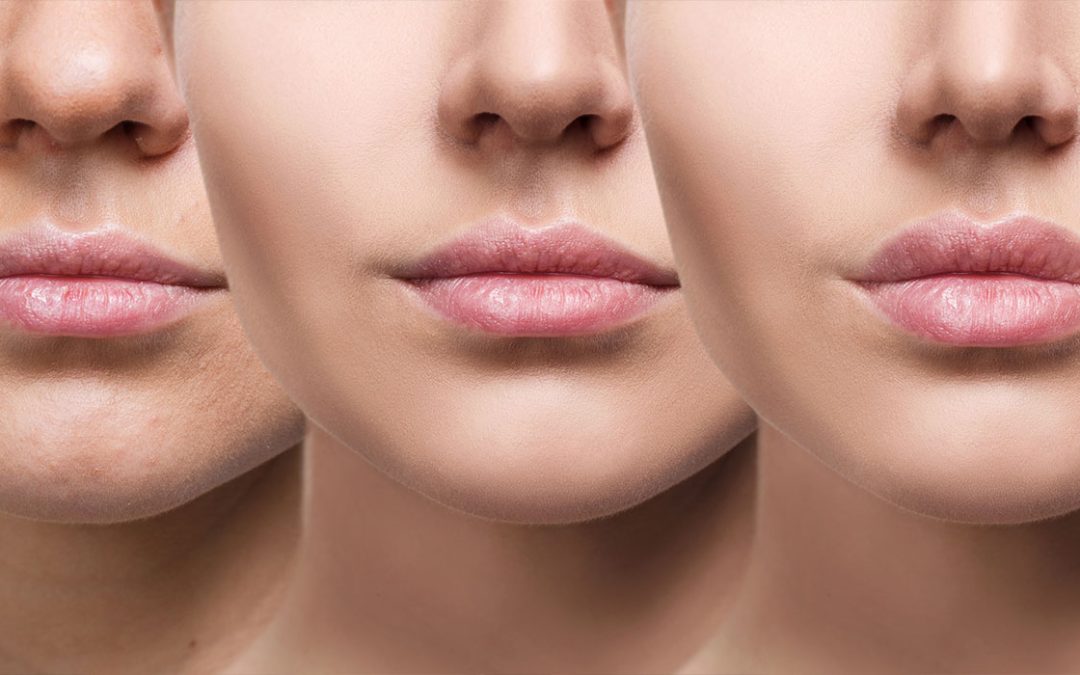 The Art of Lip Augmentation: Enhancing Your Natural Beauty