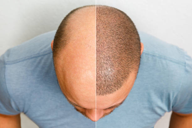 How is Hair Transplant Done?