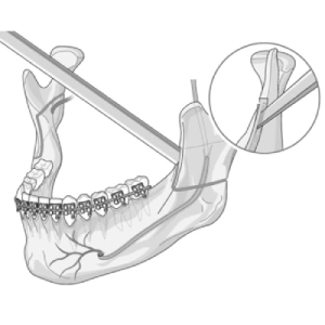 Bilateral Sagittal Split Osteotomy (BSSO)