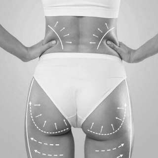 Buttock Liposuction in Thane