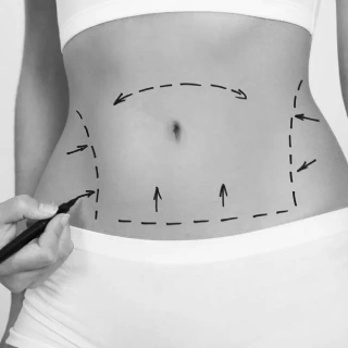 Liposuction surgery