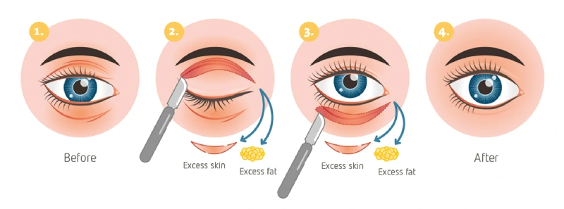 blepharoplasty procedures in Thane