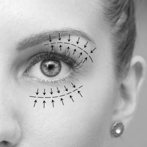 Blepharoplasty treatment in Thane