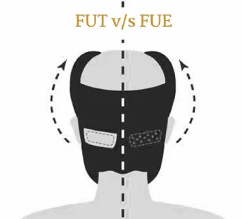 best hair transplant in thane FUT VS FUE