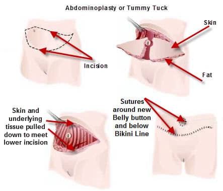 surgery-details-image