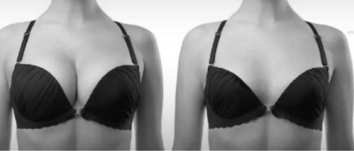 Breast reduction surgery in Thane