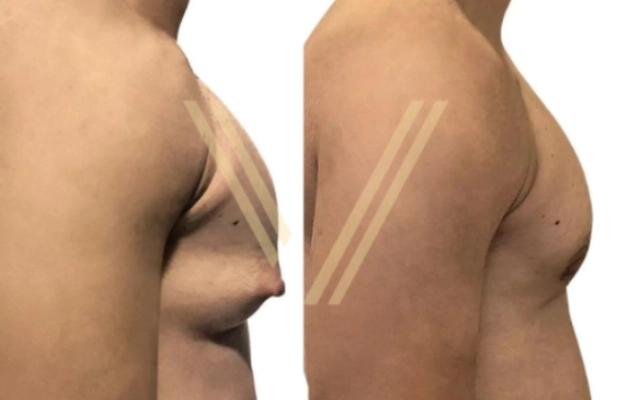 Gynecomastia