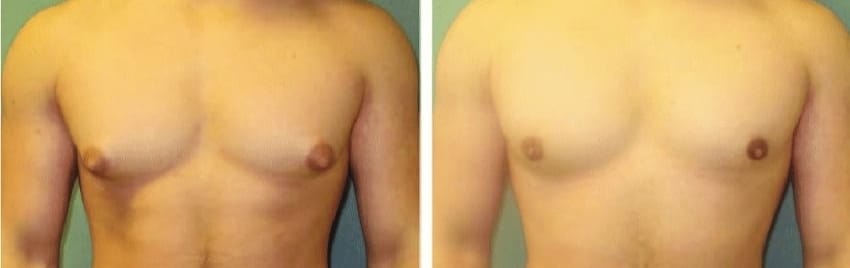 Liposuction is a common surgical technique used to address gynecomastia