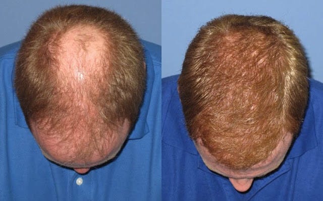 FUE Hair transplant