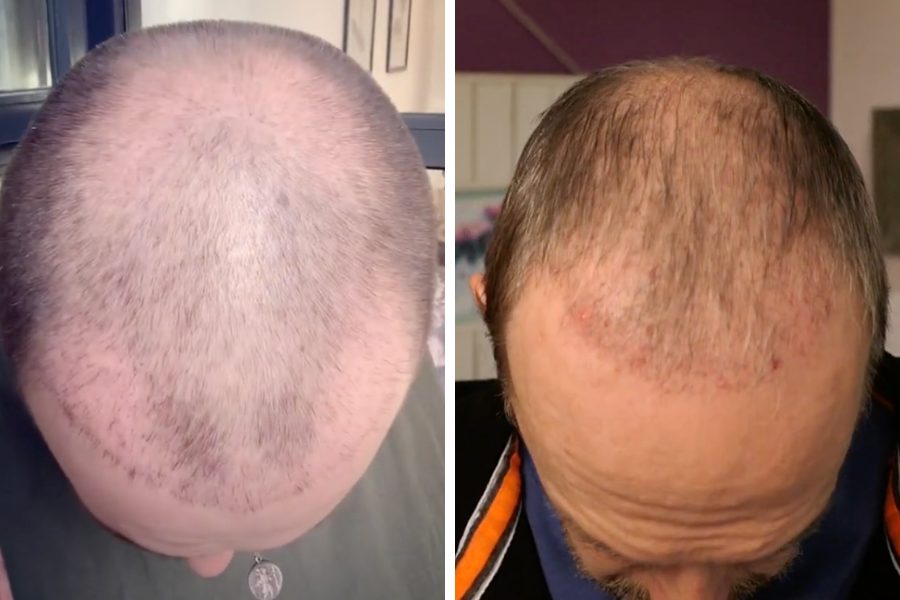 The FUT (Follicular Unit Transplantation) hair transplant