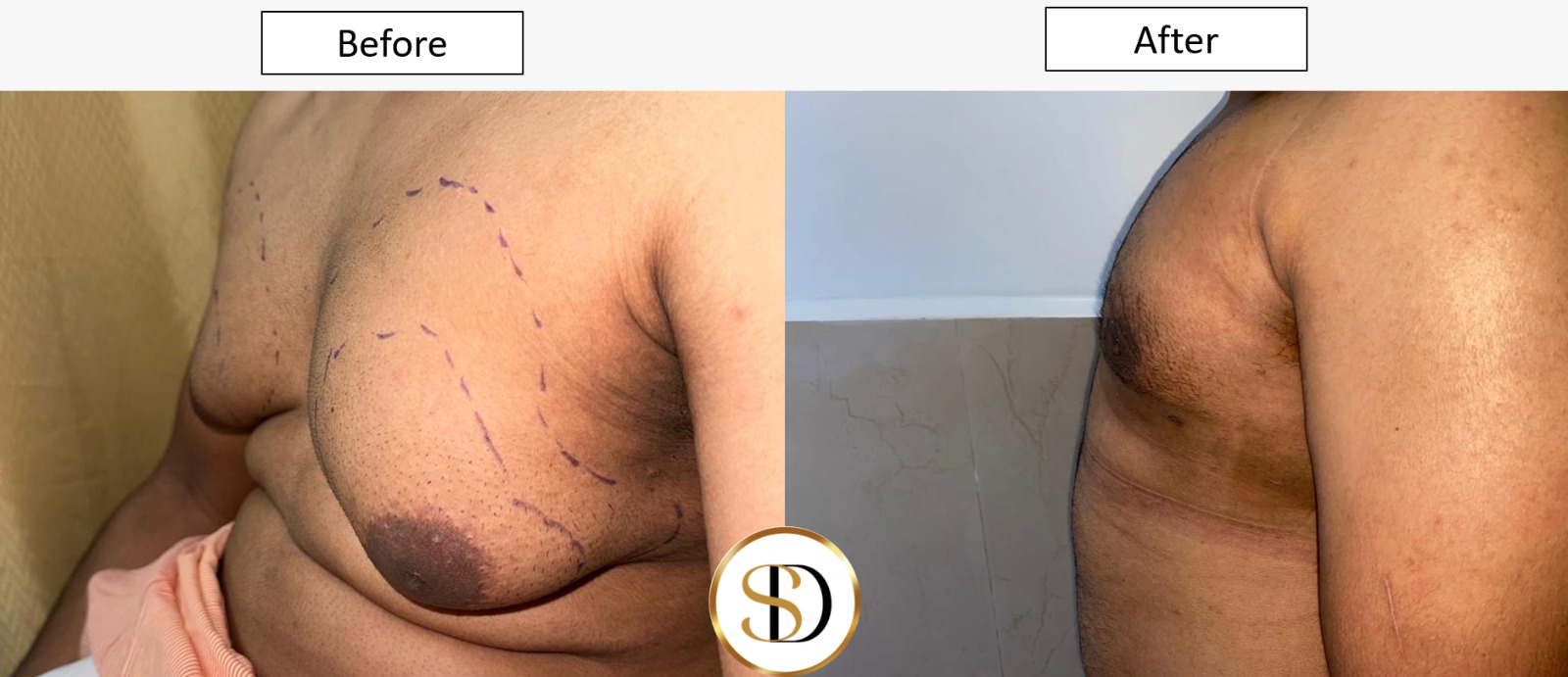 Best gynecomastia doctor in Thane