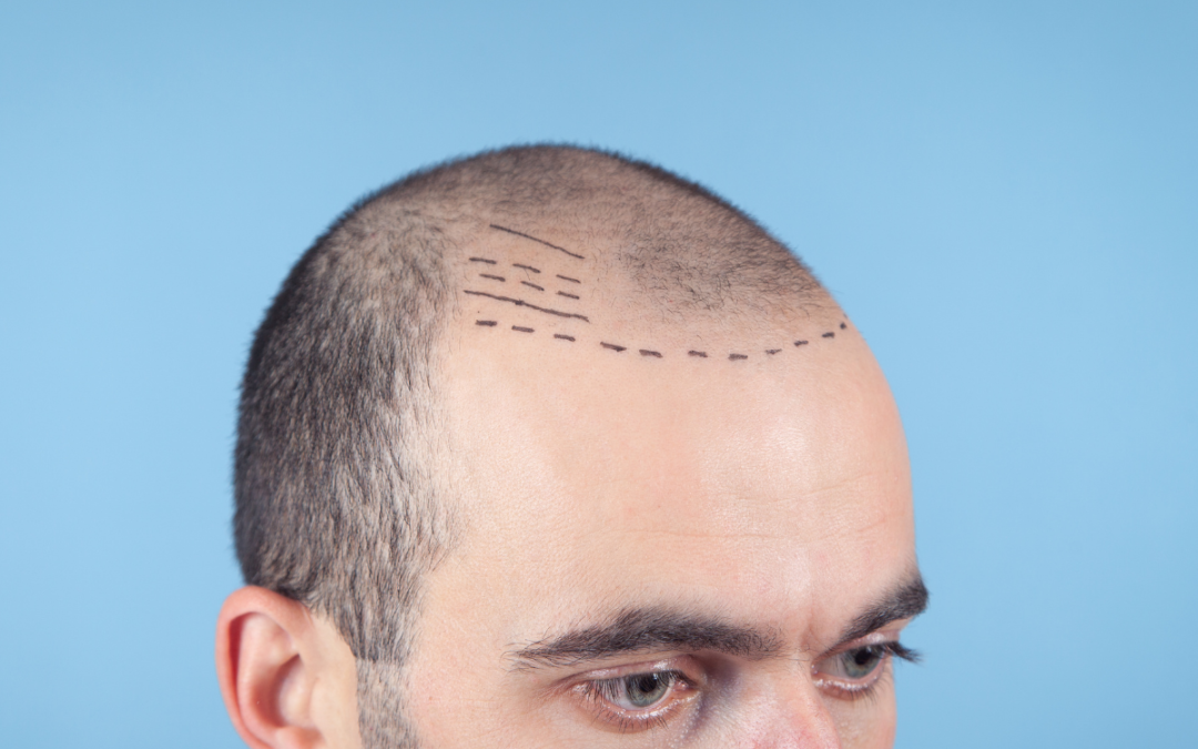 Understanding Follicular Unit Transplantation: A Comprehensive Guide