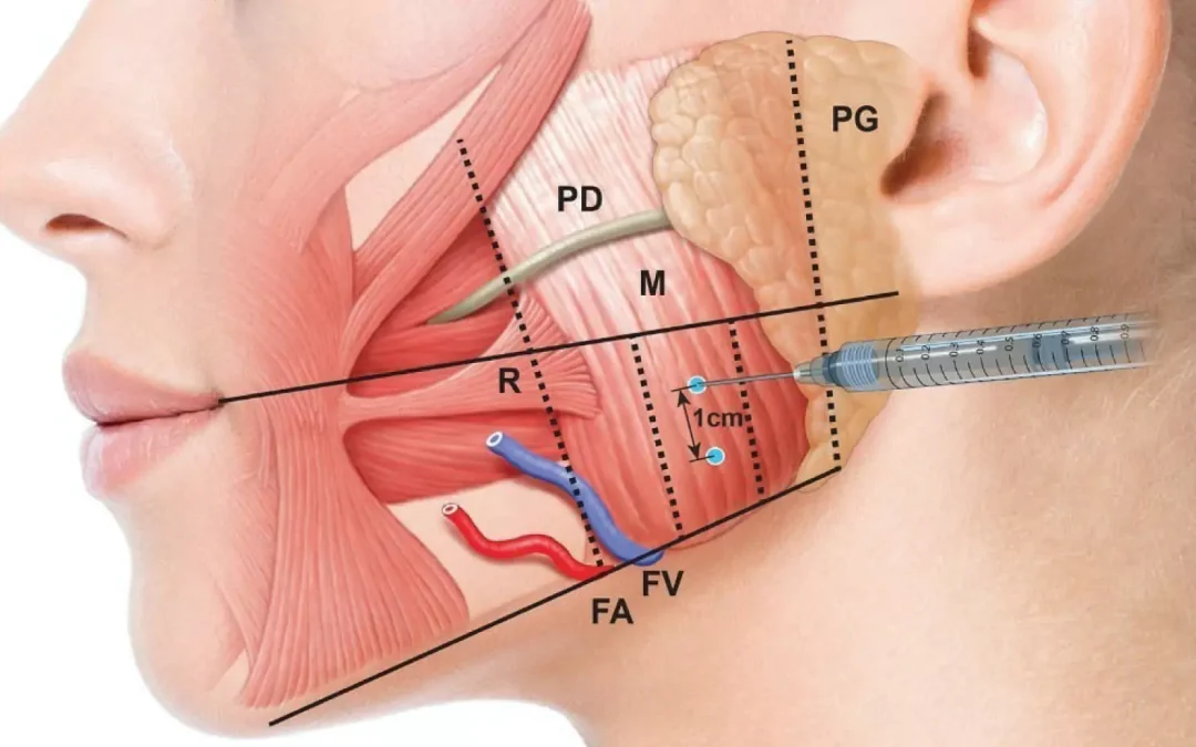 Masseter Botox: Benefits, Procedure, and What to Expect