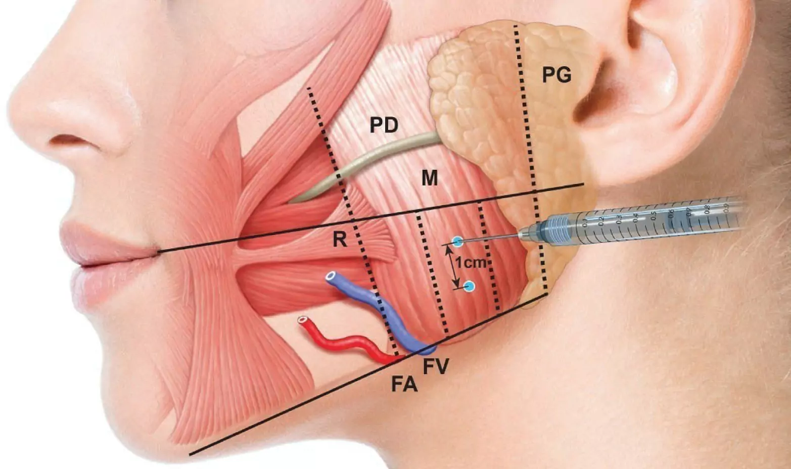 Masseter Botox: Benefits, Procedure, and What to Expect - Dr. Sagar Daiv