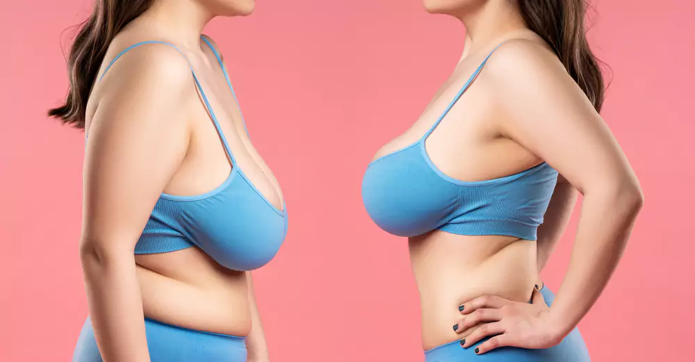 Guide to Breast Reduction Surgery