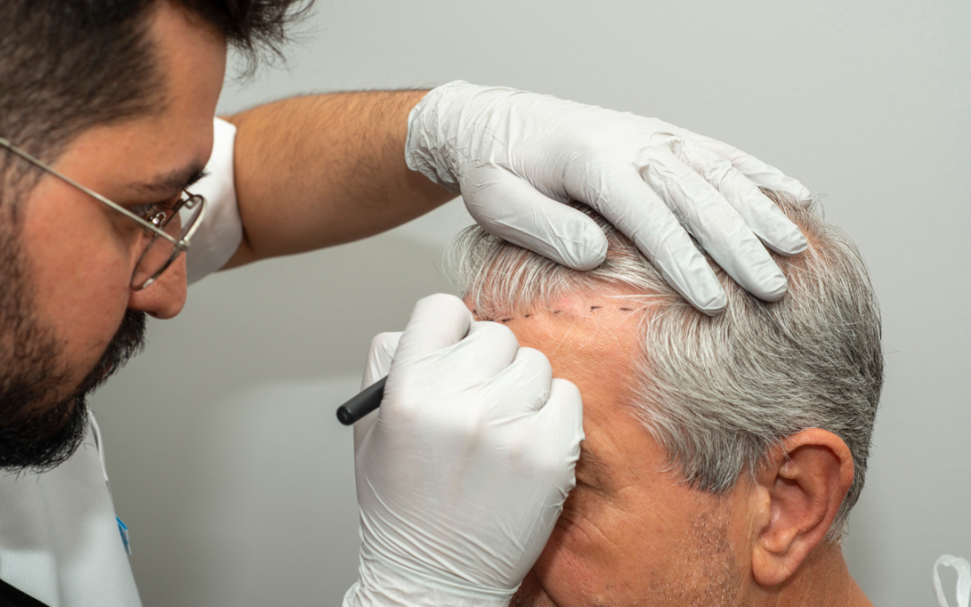 You Need to Know About Hair Transplant in Andheri, Mumbai