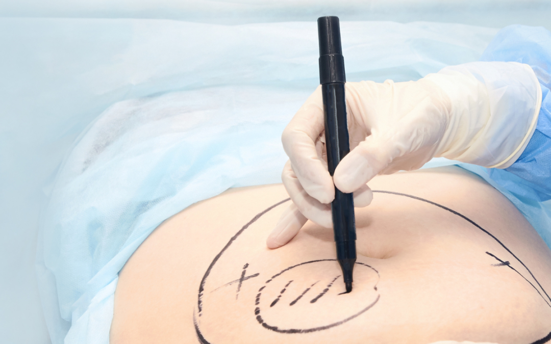 Liposuction Surgeon in andheri