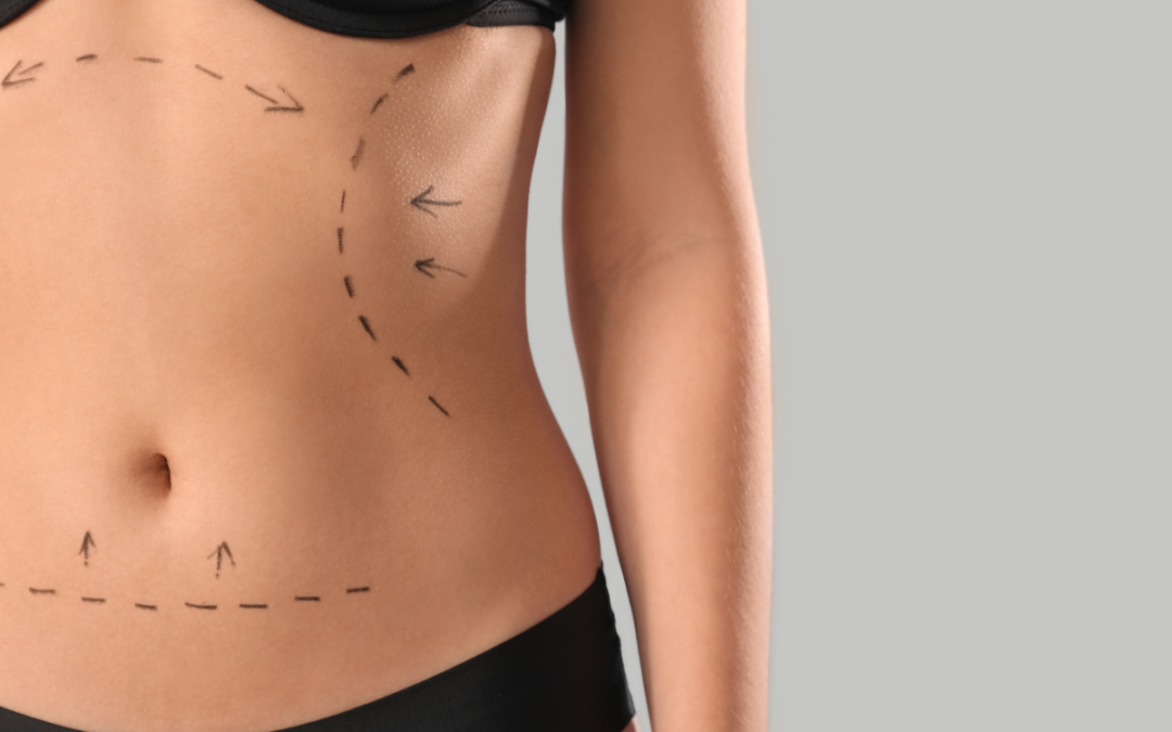 Why Consulting a Liposuction Surgeon in Andheri Can Transform Your Body Goals